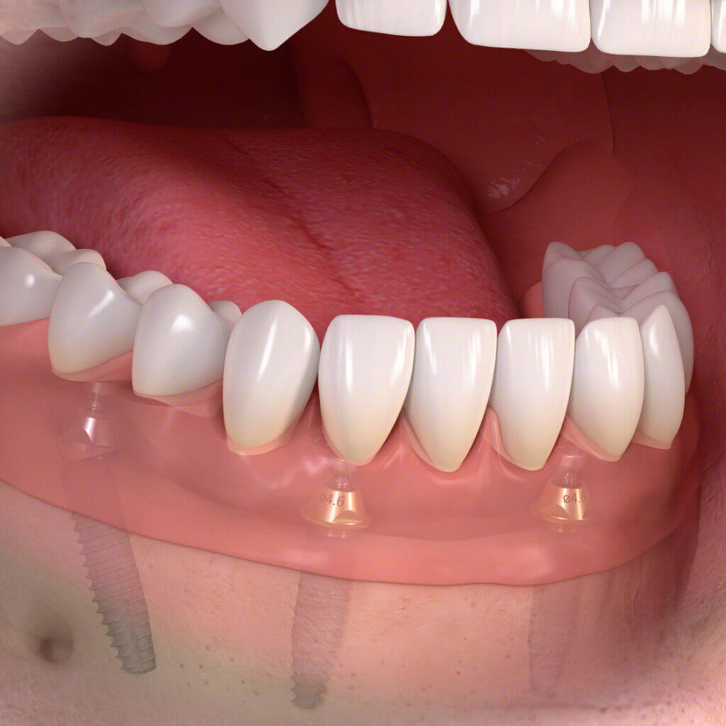 Dental Implants after treatment results - Viva Dentistry Hurstville success case