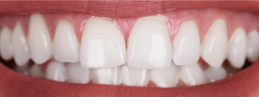 Teeth Whitening after treatment results - Viva Dentistry Hurstville success case
